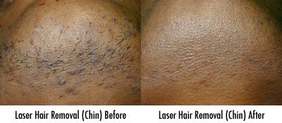 equipamento da beleza do laser do Nd Yag da máquina 1064nm da remoção do cabelo do laser do Alexandrite 755nm